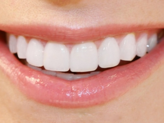 porcelain-veneers